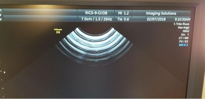 GE RIC5-9-D Ultrasound Transducer