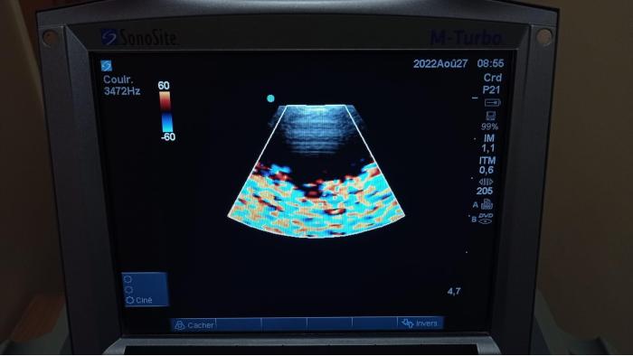 SONOSITE P21x