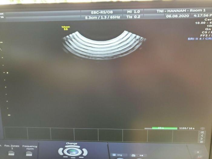 GE E8C-RS Ultrasound Transducer