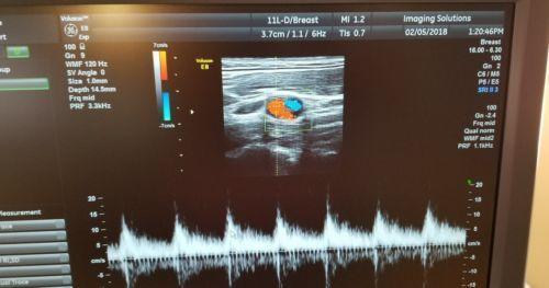 GE 11L-D Ultrasound Transducer