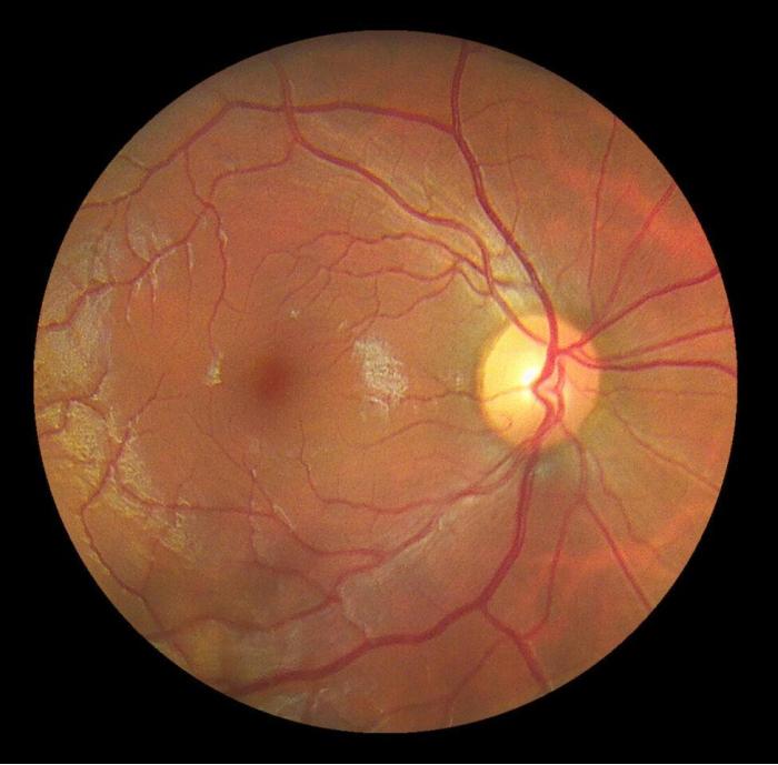 DEC 1000P Fundus Camera