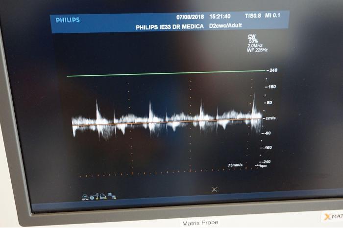 Philips iE33 G card Matrix