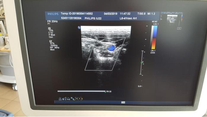 Philips iU22 G.1 2011 FULL OPTIONS Cardiac Endovaginal ETC