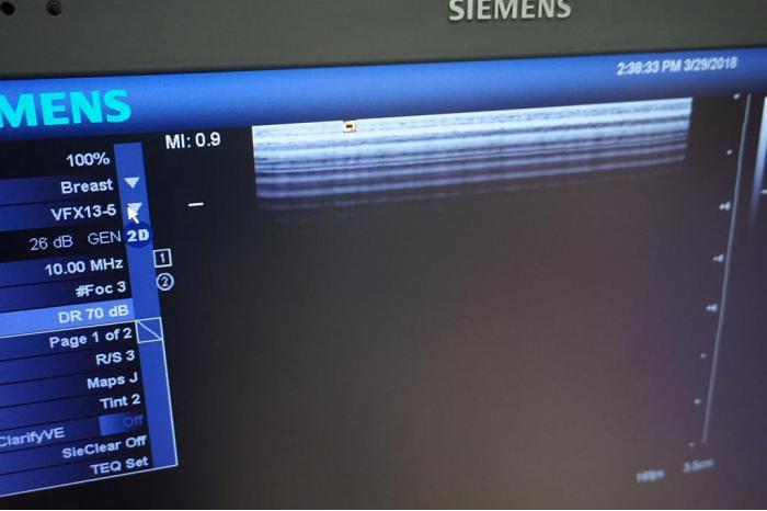 SIEMENS Sonoline Antares